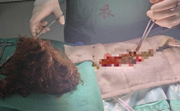 发现1例，25岁女子确诊！胃里取出2斤，密密麻麻！有人因羞耻延误就医