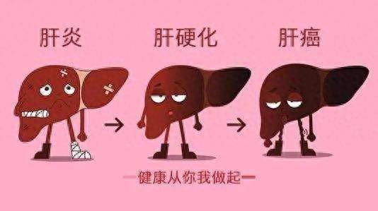 肝硬化能治好吗（肝硬化能不能治好）