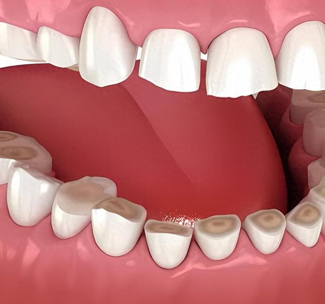 睡觉磨牙治疗最简单有效的方法是什么啊？（晚上磨牙怎么办4 个小妙招条条有用）