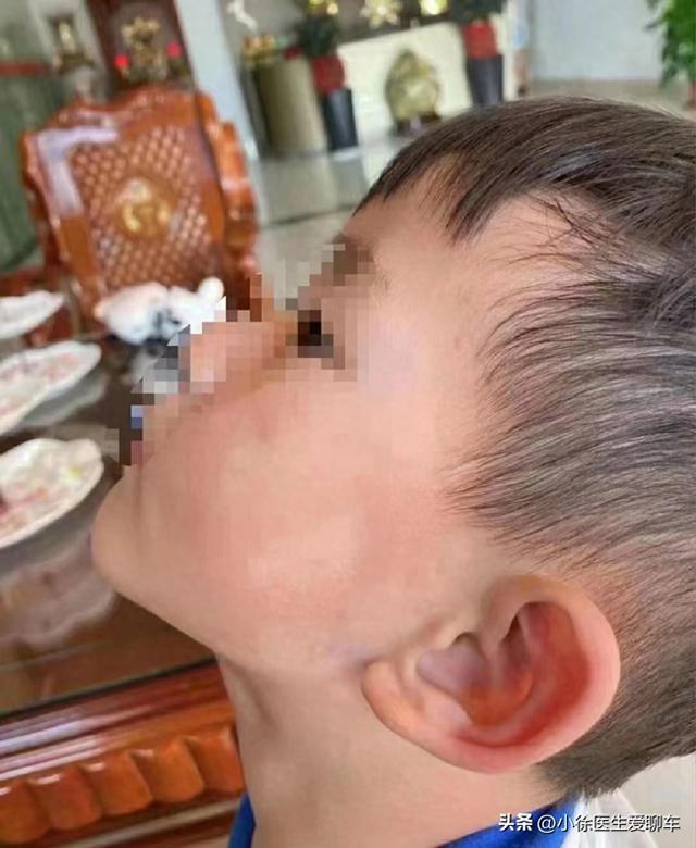 白色糠疹怎么治疗（白色糠疹频发难消）