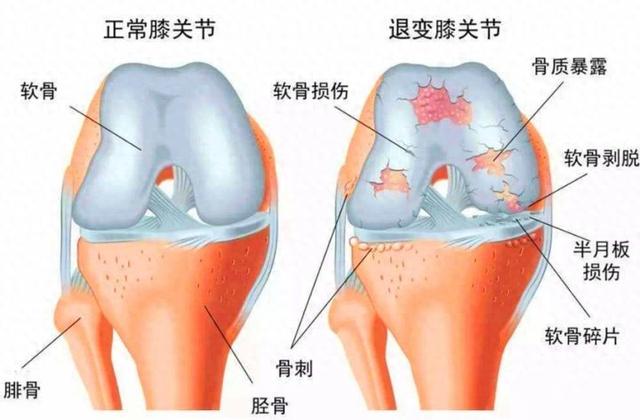 膝关节总是弹响.不疼痛（膝关节有弹响怎么办治疗还是放任不管医生给你说清楚）