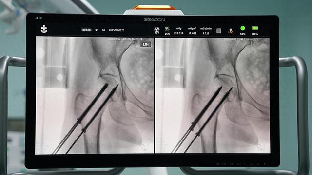 昆明骨科医院成功完成一例AI机器人辅助股骨颈骨折复位内固定术