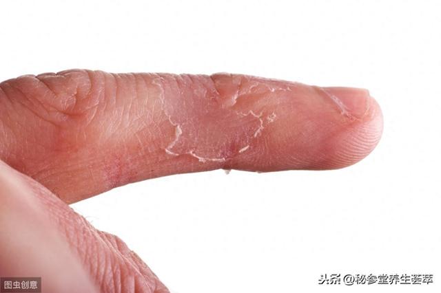 手指脱皮快速恢复方法有哪些（手指脱皮）