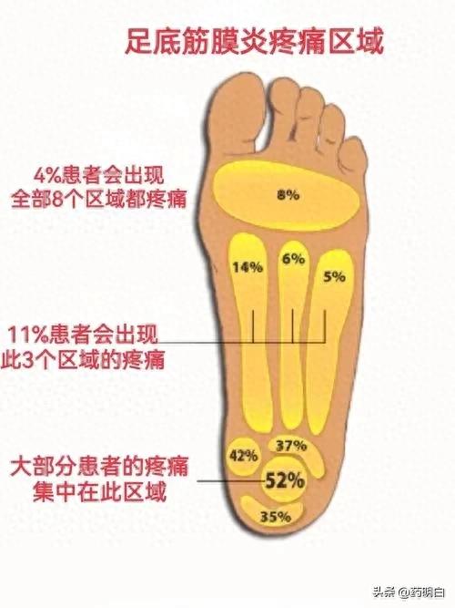 脚掌痛是怎么回事（足底筋膜炎足中或足跟痛）