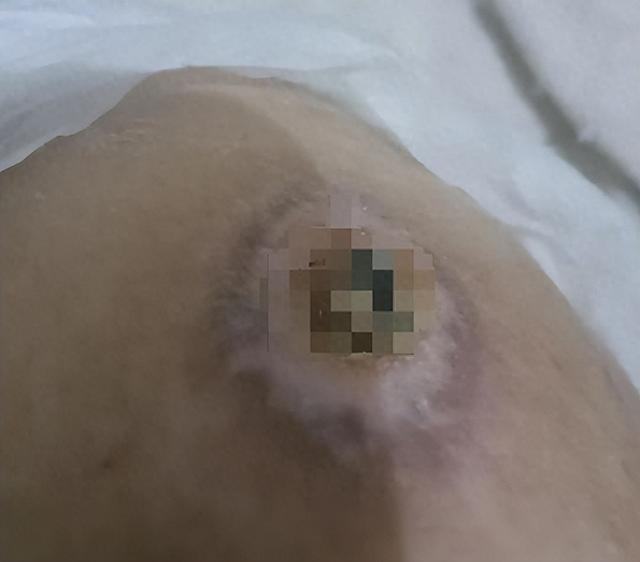 得了褥疮怎么办？好心医生帮忙（得了褥疮到底该怎么办做好以下三步帮你解决大部分问题）