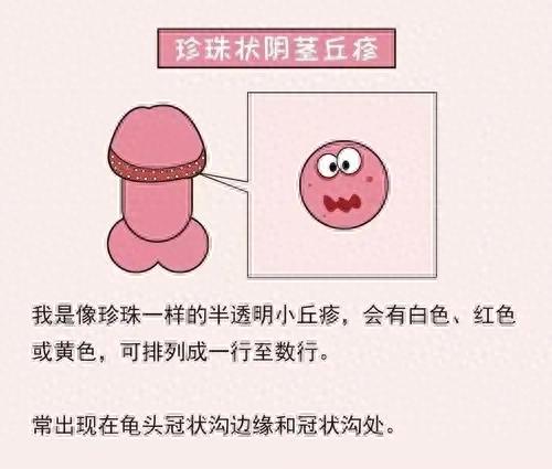 包皮上面长了许多白色硬硬的小颗粒,有图片（阴茎龟头上有小颗粒）