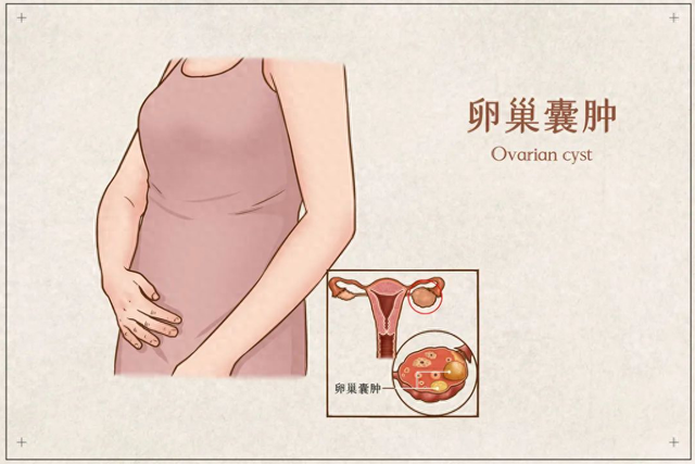 卵巢囊肿是怎么形成的?（卵巢囊肿是怎么形成的切记不要做这件事）