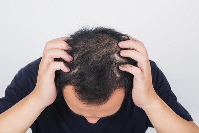 《细胞》：解决秃顶问题，科学家发现脂肪细胞居然能帮大忙