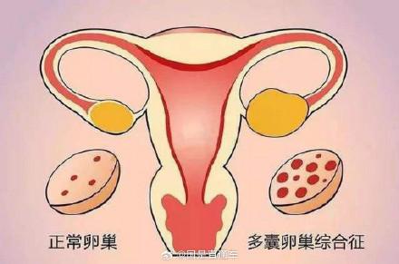 多囊卵巢的症状（什么是多囊卵巢综合征多囊卵巢综合征有哪些症状）