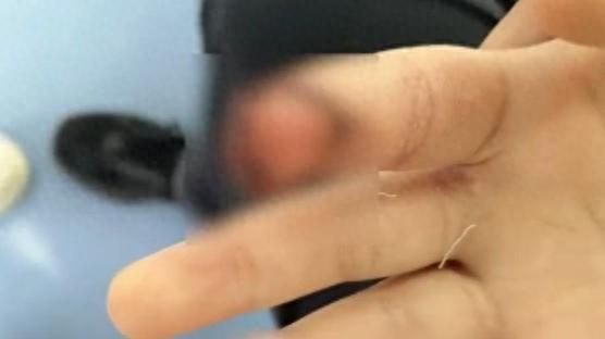 7岁女孩投喂汗血宝马被咬伤手指，父亲：一辈子带点残缺！景区：先付10万元