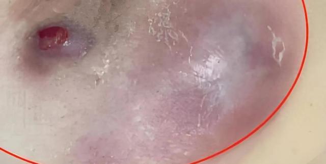 乳腺炎怎么看出化脓了（肉芽肿性乳腺炎化脓怎么办别慌）