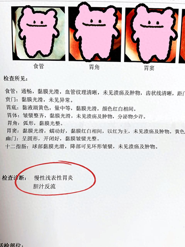 浅表性胃炎伴胆汁反流的症状有哪些（慢性浅表性胃炎伴胆汁反流）