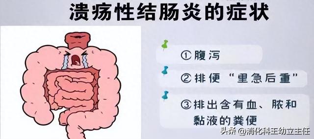 优化溃结方（100 个溃结 90 个脾虚5 味药精简方）