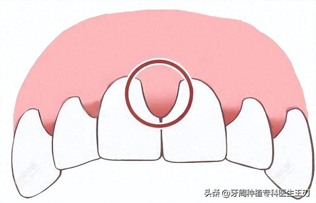 牙龈增生是怎么回事?怎么办?（牙龈增生的原因和治疗方法）