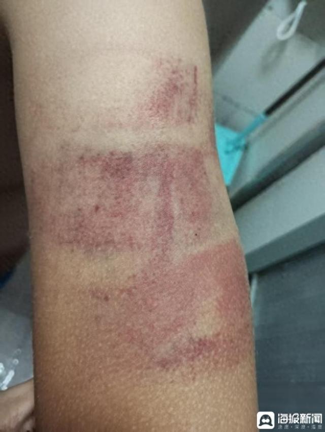 福建厦门一小学生因作业丢失 被老师打致轻微伤 律师：家长可以要求老师赔偿