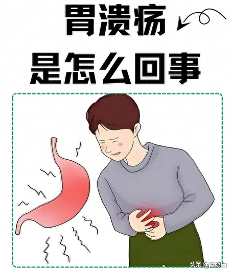 胃溃疡好发哪个部位（胃溃疡是怎么回事）