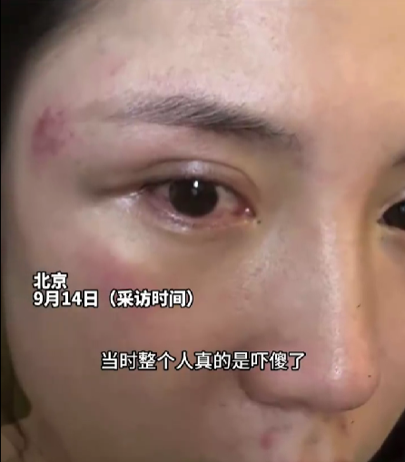 暖爆全网！冰雹砸伤女子两大哥冲上前护送 专家支招户外遇冰雹如何自救