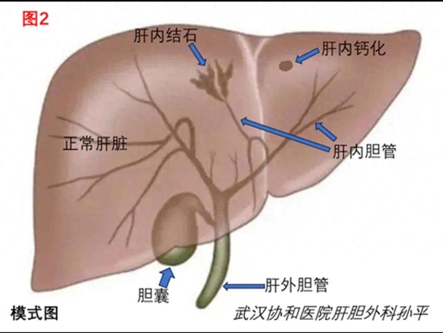 肝上有钙化点是怎么回事应该注意什么（肝脏伴钙化是怎么回事怎么办）