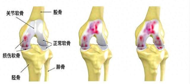 膝关节不好的人注意！医生劝告：这3种运动最伤软骨，尽量避开