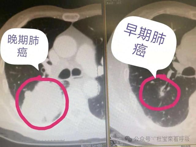 如何辨别肺部良性结节（肺结节有以下6个特征）