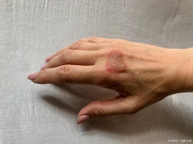 水泡破了怎么办（纠结烫伤水泡要不要弄破先看这几点）