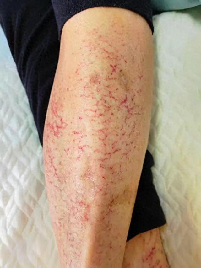 女子连续3天打麻将，双腿长出“蟒蛇纹”！电暖麻将桌：这锅我不背