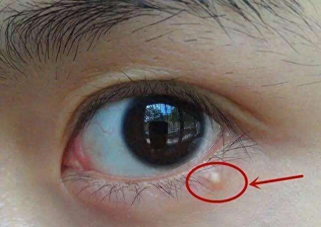 如何确诊是不是脂肪瘤（身上长得脂肪瘤有什么危害）