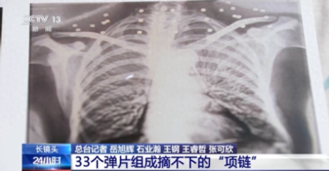 森林勇士破解版下载（33个弹片成了老兵摘不掉的项链）