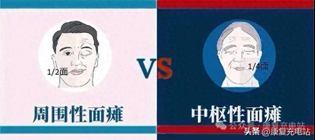 中枢性面瘫和周围性面瘫区分思路