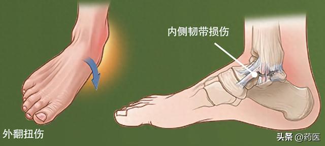 怎么样快速正确拉韧带（韧带损伤后）