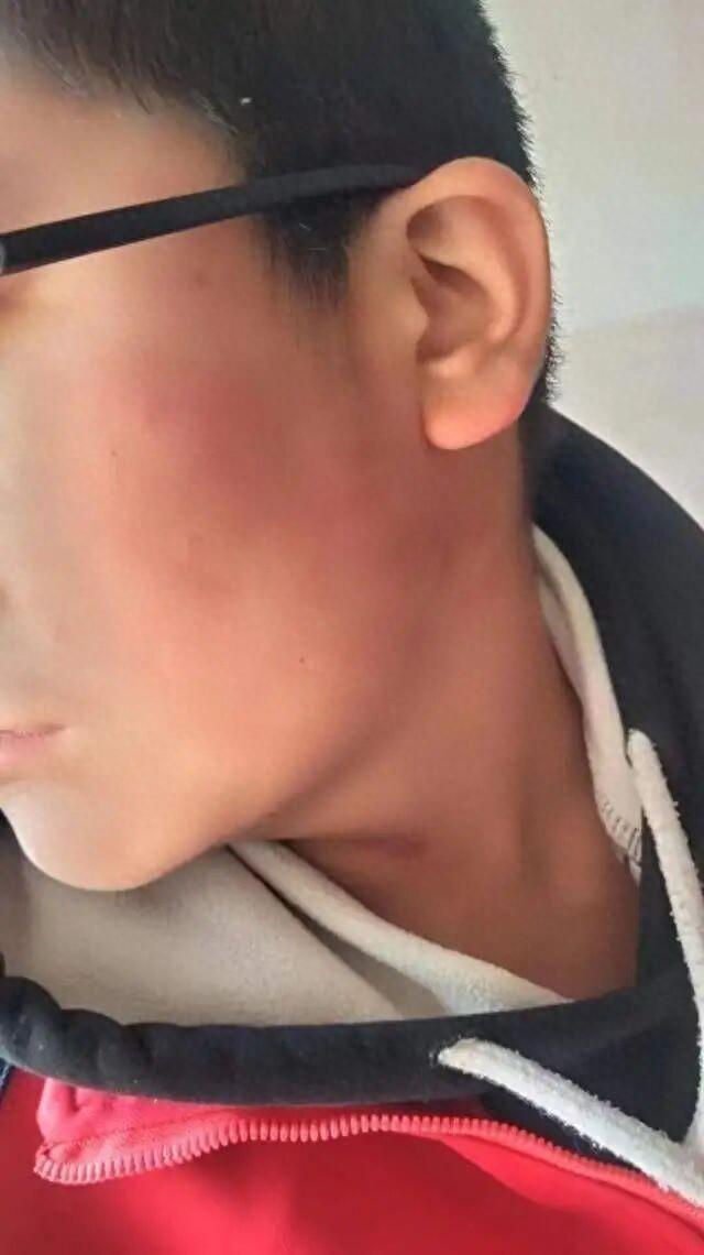 13岁男孩遭老师掌掴后视网膜脱落致九级伤残，法院判校方赔70.6万元	，家属就“护理费”问题再诉