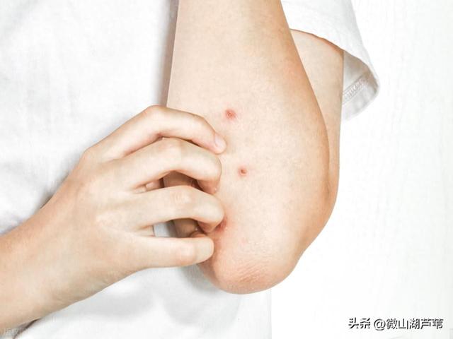 浑身刺痒是什么原因,该怎么治?（皮肤瘙痒别乱挠）