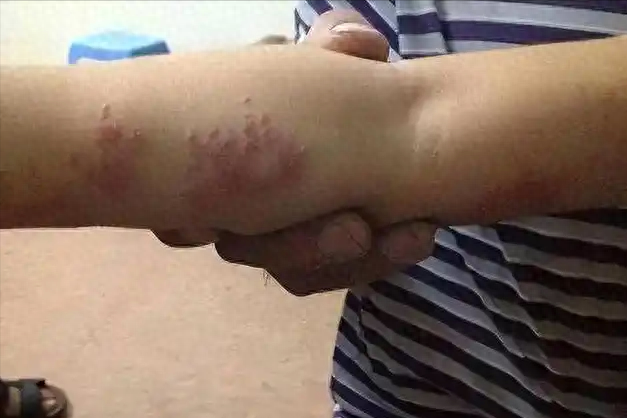 女人若是感染了“艾滋病”，胳膊上或有4种症状，都以为是皮肤病