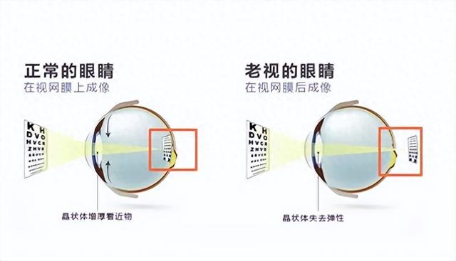 优化眼睛手术（眼科医院健康科普老花眼不可怕）