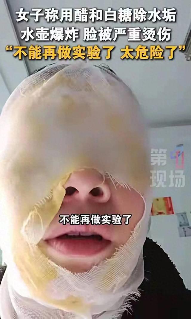 醋+白糖去水垢竟引发爆炸,女子脸部烫伤!家务必看!