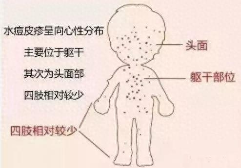 水痘的症状和图片有哪些呢（水痘十问）