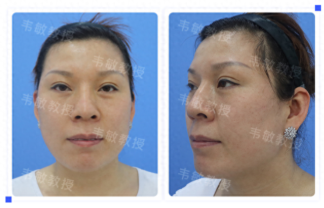 脸型优化（生硬U型脸也能变成柔和小脸）