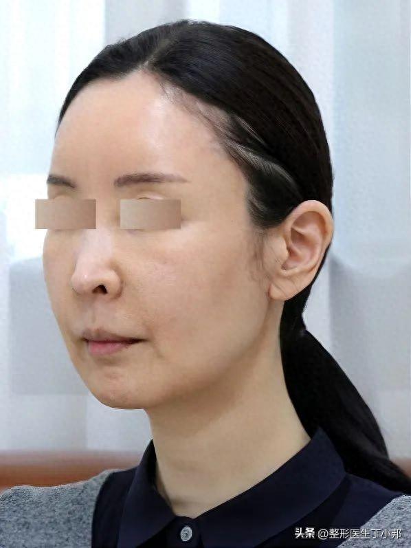 45岁瑜伽老师“受刺激”后，飞北京做面部提升，术后7天变女神