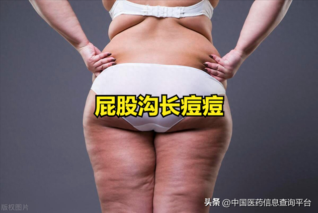 屁股沟突然长了一个疙瘩（屁股沟长痘痘）
