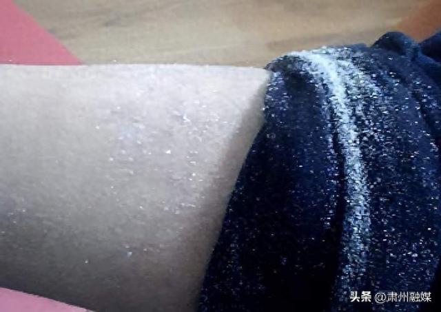 全身脱皮屑像头皮屑一样（一脱衣服身上很多皮屑脱落）