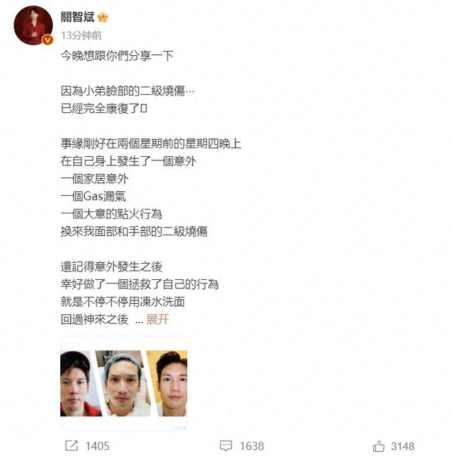 关智斌自曝煤气意外漏气致面部二级烧伤，公开康复期照片惹人心疼