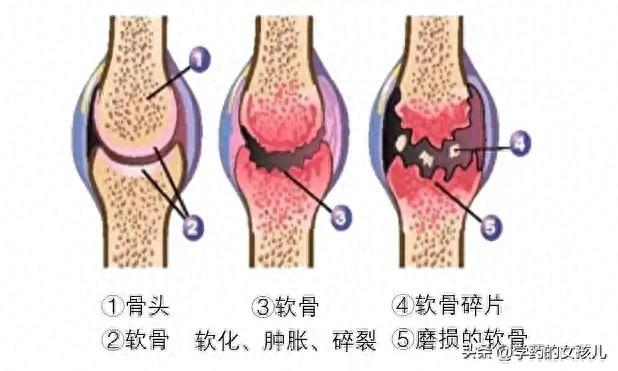 硫酸氨基葡萄糖胶囊的作用及禁忌症（氨基葡萄糖胶囊治疗骨关节炎）