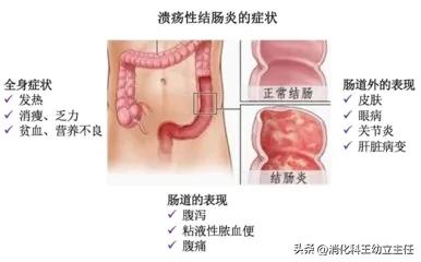 为什么美沙拉嗪不能停（溃疡性结肠炎美沙拉嗪篇该怎么用）