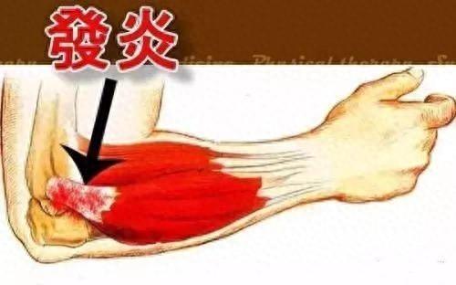 网球肘如何进行按摩?（网球肘反复发作）