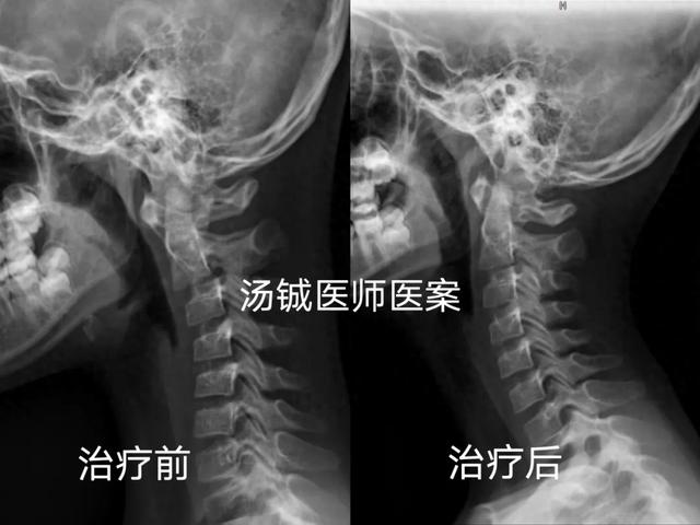 颈椎反弓怎么治疗缓解?（颈椎反弓需要治疗吗能不能恢复今天给你答案）