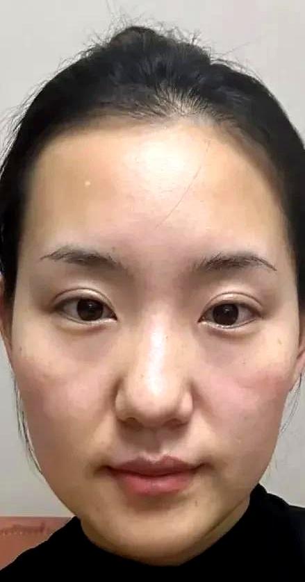 吹瓶子 67 天，法令纹淡到像开了美颜！急性子加个咬筷子，效果