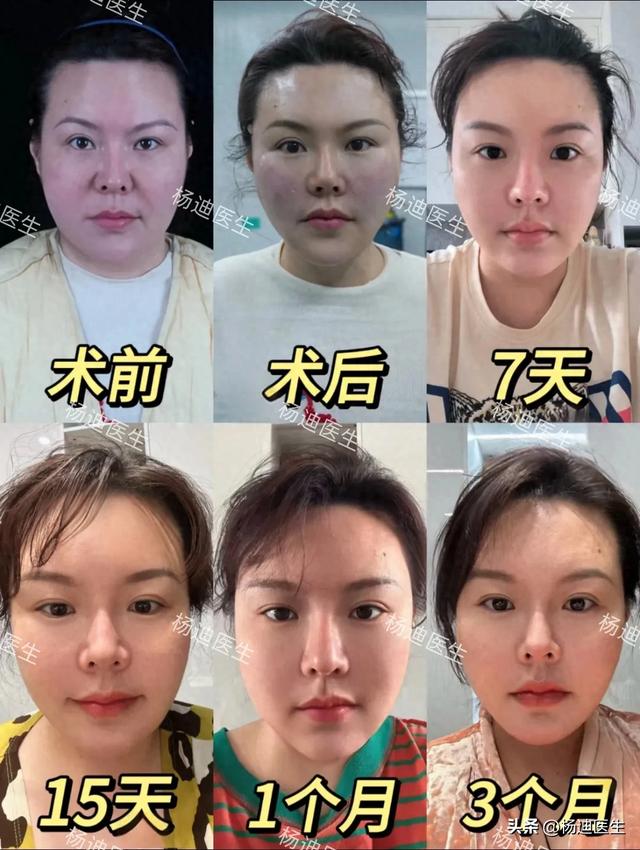 花4.5万做面部提升，闺蜜却说“整容脸”！真的有那么假吗？