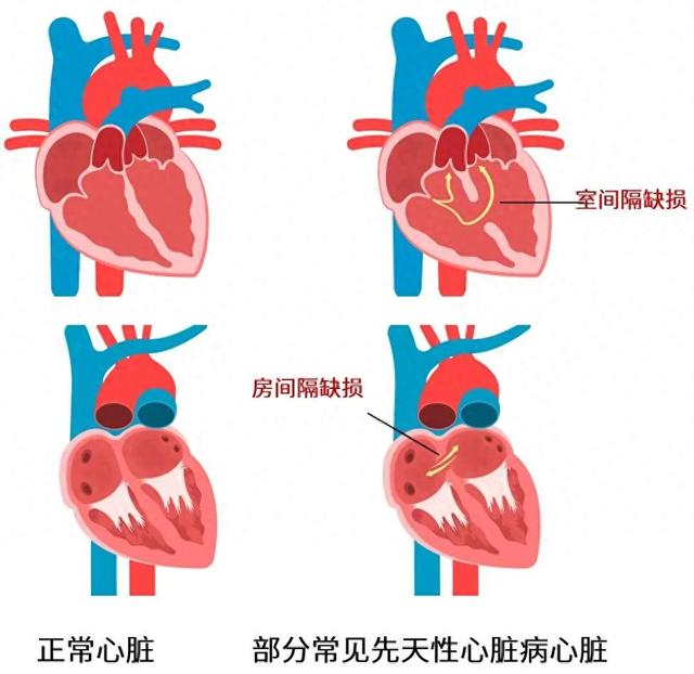房间隔缺损是怎么回事（房间隔缺损）