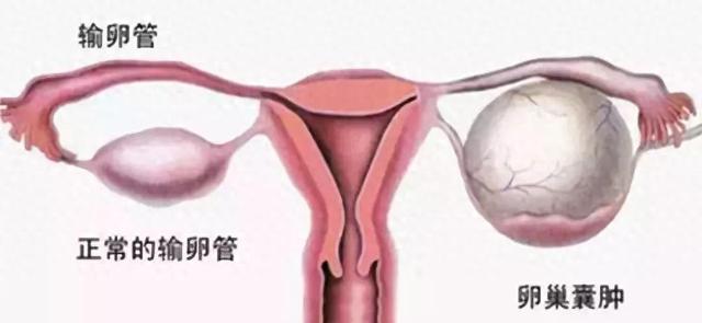 卵巢囊肿早期五大症状是什么?（卵巢囊肿有什么症状出现这4个症状）