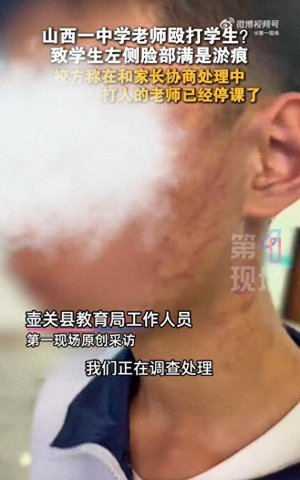 快评丨老师打学生致多处淤痕，教育惩戒不能演变成“故意伤害”